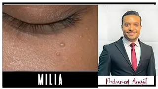 حبوب الميليا اسبابها و علاجها و ازاي تتخلصي منها في دقيقة واحده بس 