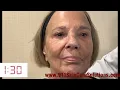 Secret to Removing Wrinkles in 3 Minutes Dr Sevinor Wrinkle Solution Serum