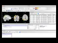 fMRI Short Course 3rd-Level Analysis