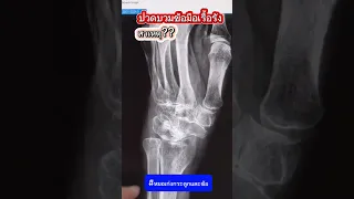  ข้อมือซ้ายที่มีอาการปวดเรื้อรังและก้อนนูน มีสาเหตุมาจากอะไร 