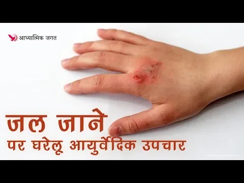 Download MP3 Homemade Remedies for Burn - जल जाने पर घरेलू आयुर्वेदिक उपचार