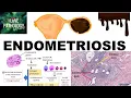 ENDOMETRIOSIS Etiopathogenesis Cinical features and Pathology