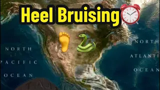Heel Bruising