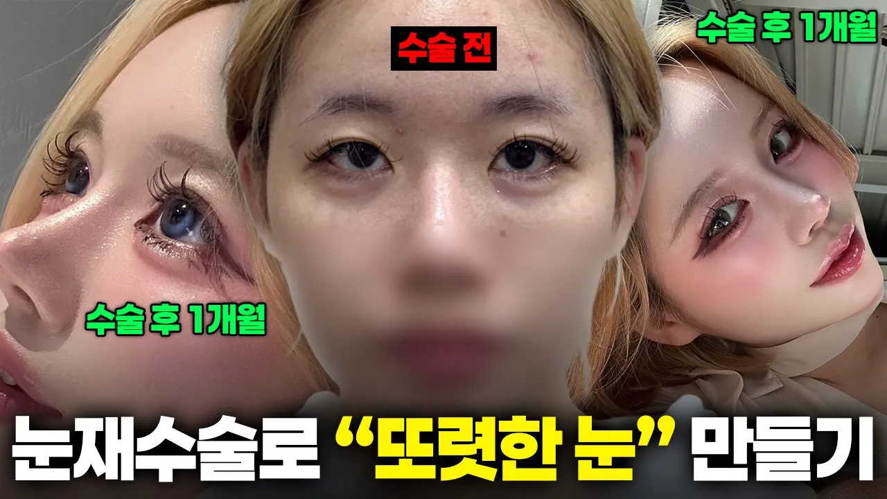 또렷한 눈을 만들고 싶어서 고민 중 이라면 주목! | 성형 쇼츠 모음▶️