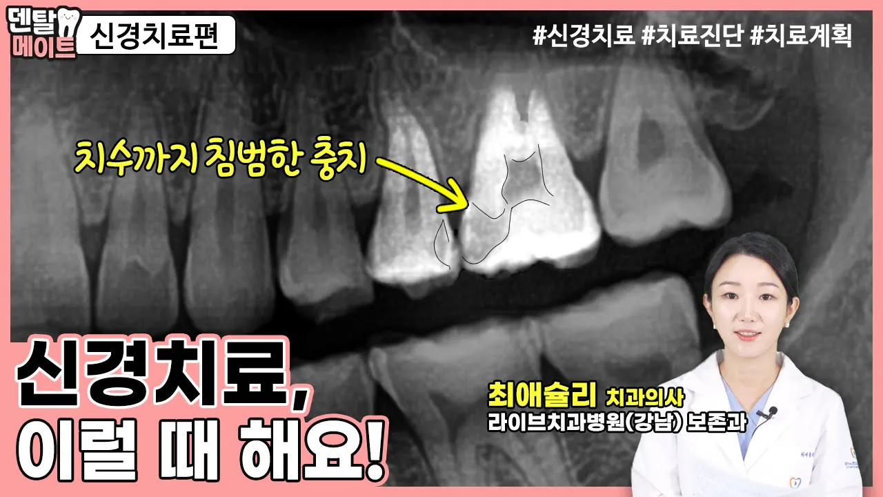 신경치료 이럴 때 해요!  [신경 치료, 신경손상 자가확인법, 신경 치료 과정]｜덴탈메이트