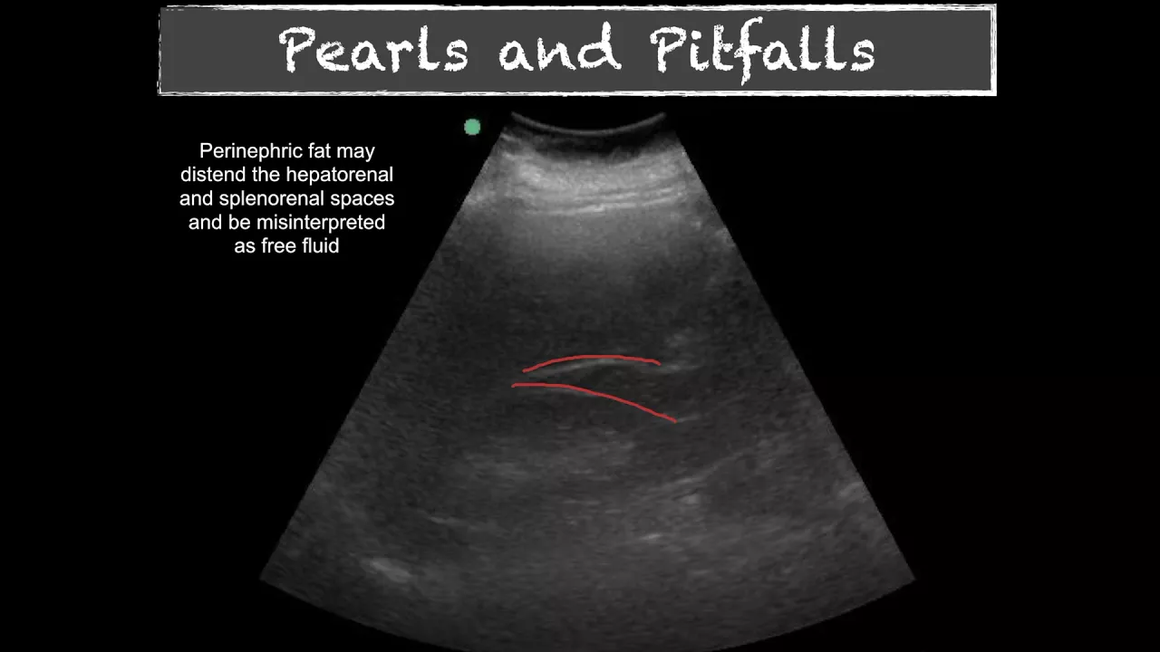 POCUS - E FAST - Pitfalls