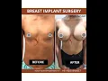 Breast Enlargement Before After Breast Enhancement Before After