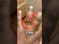 Download Lagu how to remove a ring stuck on finger