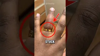 How To Remove A Ring Stuck On Finger 