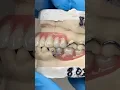Download Lagu Maxillary and Mandibular Titanium Partials #lsk121shorts #dentist #teeth
