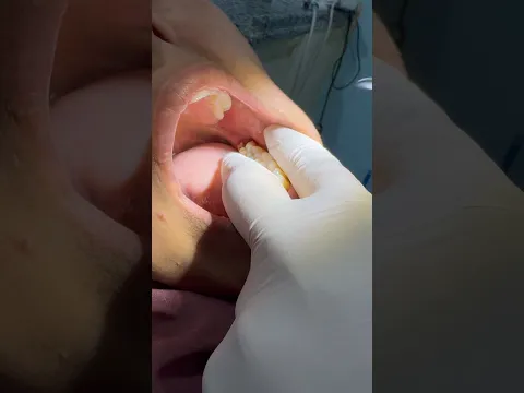 مش هتصدق ضرس العقل اتخلع في كام ثانية! | Fast Wisdom Tooth Extraction