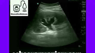 Pyonephrosis