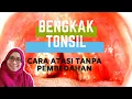 Download Lagu Bengkak Tonsil : Cara Atasi Boleh Elak Pembedahan