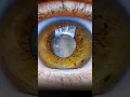Download Lagu Animation - how Eye Cataract surgery is done #shorts #cataract #eyes