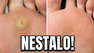 Izlečila je kurje oko sa samo 2 sastojka,a i bol je nestao...