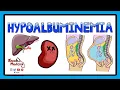 Download Lagu Hypoalbuminemia - Functions of Albumin in the Body + Pathophysiology of Hypoalbuminemia