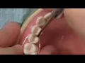 Using Teflon for Isolation Technique with Dr Jeff Davies