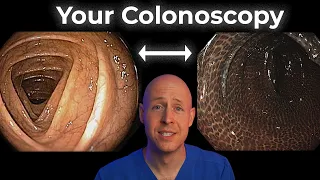 What Your Colonoscopy Findings Say About Your Gut Health