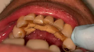 Heavy Tartar Removal.