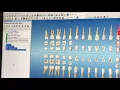 Creating a Multi-phased Treatment Plan in Dentrix