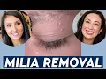 How Do You Remove Milia A Dermatologist Shares Milia Treatment Prevention Tips DERM CHAT