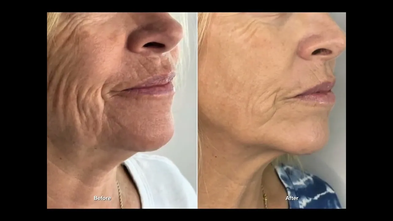 Louisa’s Microneedling Journey: Real Results, No Fluff
