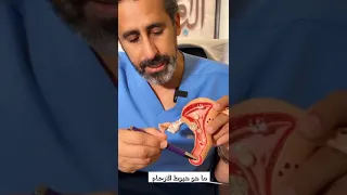 ما هو هبوط الارحام What Is Womb Prolapse 