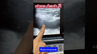  เกิดอะไรขึ้นที่เข่าของผู้ป่วยที่มีอาการบวมและเจ็บมาก 1 วัน 