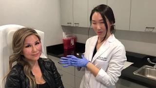 Botox For The Forehead In Between Eye Brows - Results May Vary