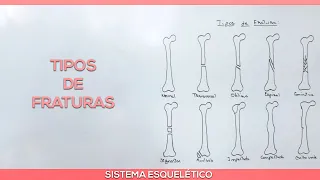Tipos de fratura