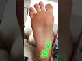 Download Lagu Not ALL heel pain is Plantar Fasciitis! #heelpain