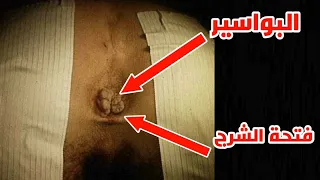 عملية البواسير بالليزر Hemorrhoids Laser Treatment 