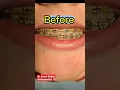 Before After Braces Removal Appointment