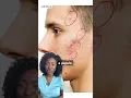 Download Lagu Red Spots on Your Face | Acne Papules + Products #acne