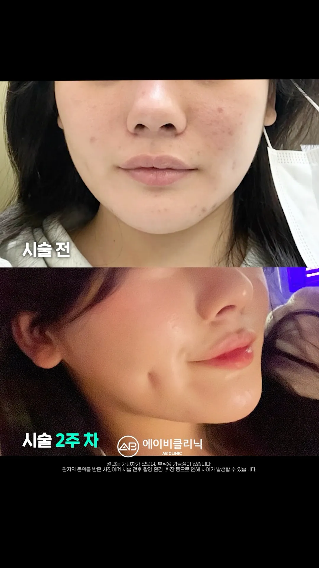 피부 좋은 사람은 다 하는 리쥬란 후기