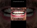 Clear Braces Before and After Invisalign 3M Clarity Cost Pictures Orthodontic Treatment