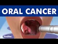 ORAL CANCER and tumors in the mouth lips and tongue