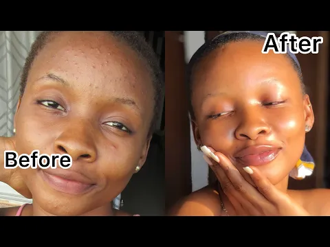 Download MP3 How I Truly Got Rid Of My Pimples In 2 Weeks | Clear Skin |