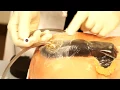 Negative Pressure Therapy Part 4 of 4 - Understand Wound Care