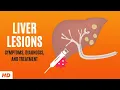 Liver Lesions Symptoms Diagnosis and Treatment