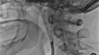 Alphenix Angiography Canon Medical Systems USA 3 