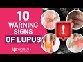 10 Vital Warning Signs of Lupus