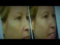 Doctors warning about plastic surgery trend