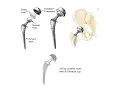 Total Hip Replacement Total Knee Replacement Part 1 Pre-operative Orthopedist Presentation