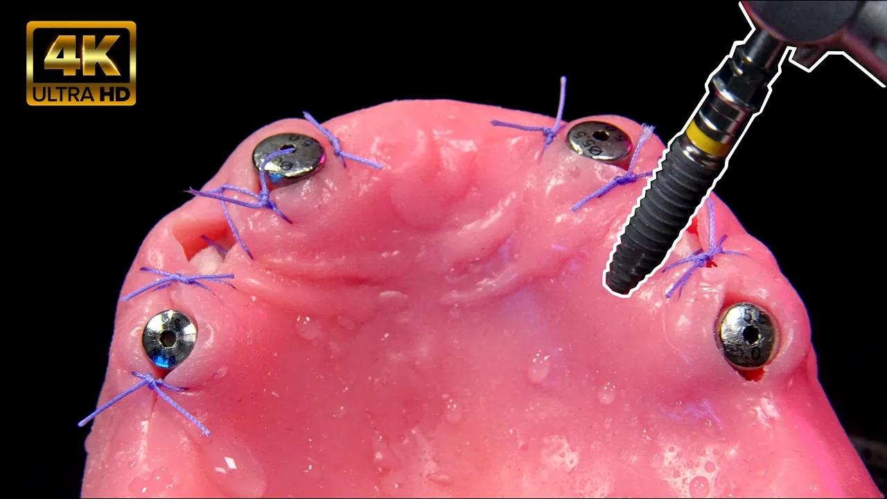 Outline Video Así es el proceso de los implantes dentales
