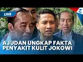 Download Lagu 🔴LIVE UPDATE: AJUDAN UNGKAP Penyakit Kulit yang Dialami Jokowi, Bantah Kena Steven Johnson Syndrome
