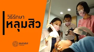 ทำไมการรักษาหลุมสิวด้วยครีมหรือกรดไม่ได้ผล