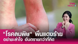มีวิธีป้องกันลมพิษอย่างไรบ้าง