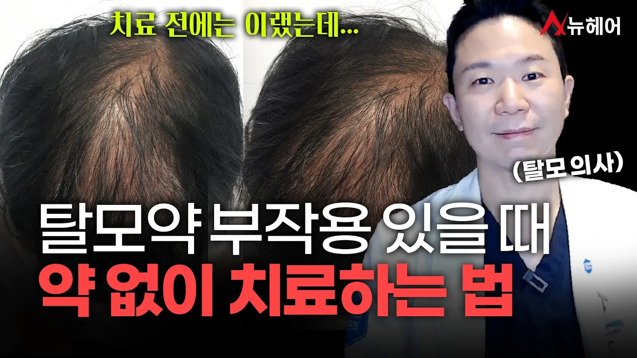 탈모약 부작용 있을 때 치료하는 법ㅣ뉴헤어