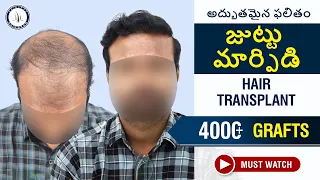 4200 గ్రాఫ్ట్స్ హెయిర్ ట్రాన్స్‌ప్లాంట్ ఫలితాలు | Amazing Hair Transplant Results #hairtransplant